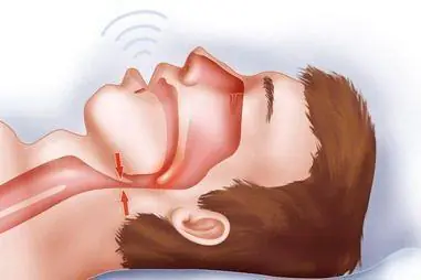 Sleep apnoea